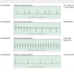 Relias dysrhythmia advanced with measurements a