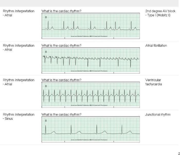 Relias dysrhythmia advanced with measurements a