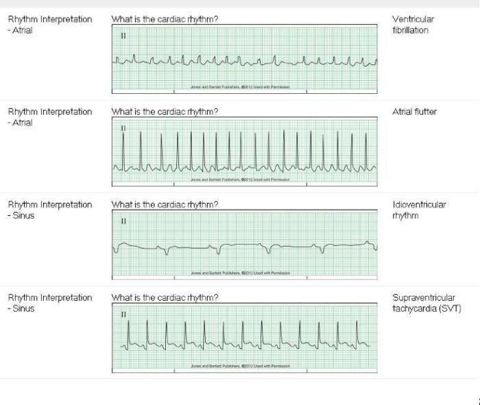 Relias dysrhythmia advanced with measurements a