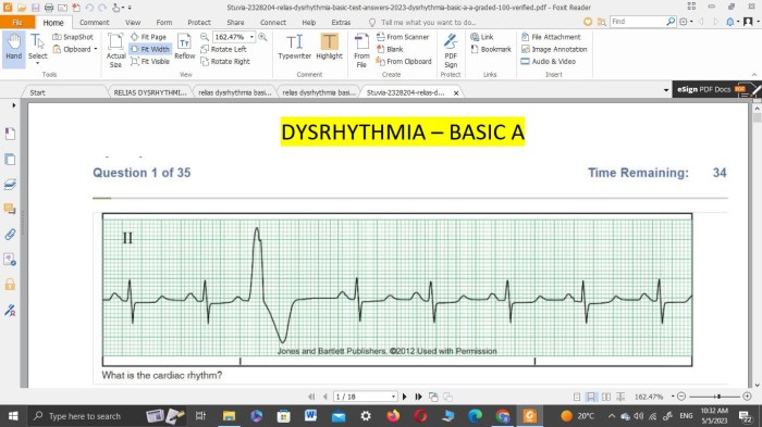 Relias dysrhythmia advanced with measurements a